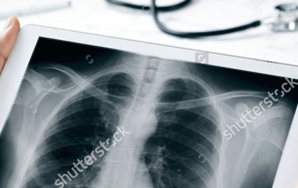 Cirurgia Torácica