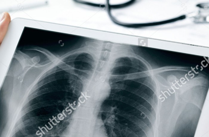 Cirurgia Torácica